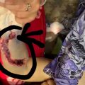 Alm Kasmawati Siregar yang kurang mendapat pelayanan dari RSUD Rantauprapat dengan kondisi Miris