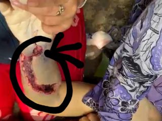 Alm Kasmawati Siregar yang kurang mendapat pelayanan dari RSUD Rantauprapat dengan kondisi Miris